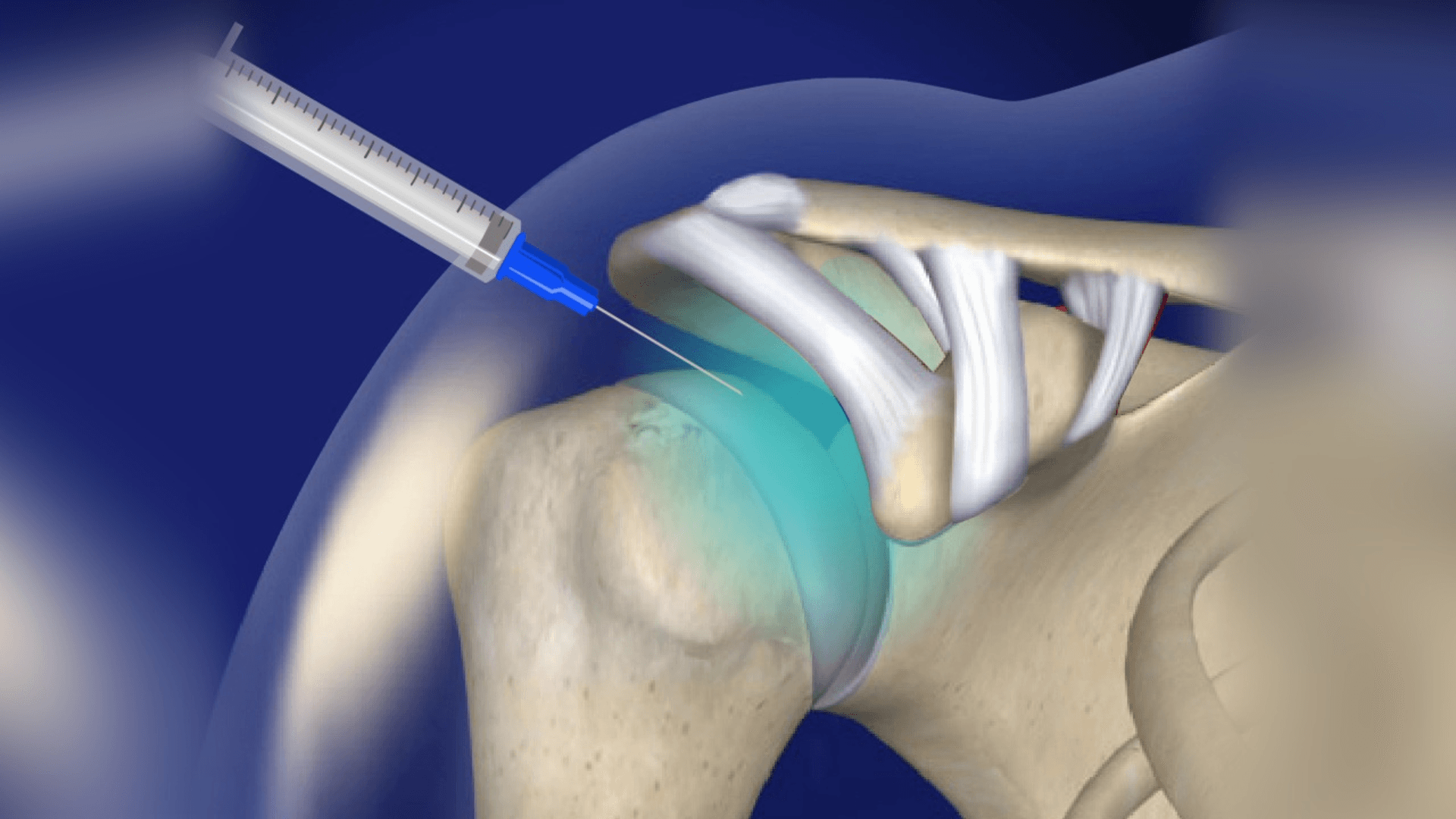 Advanced Intra-Articular Injection Therapy in Ranchi